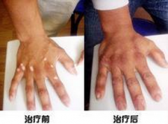 男性手部局限型白癜风康复案例