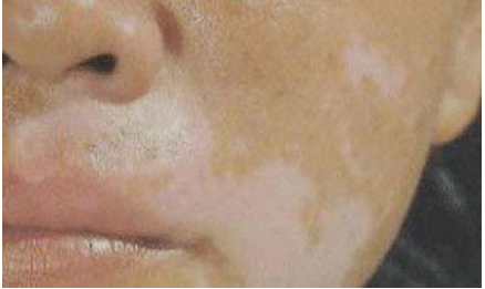 白癜风治疗费用：怎么诊断脸上白斑