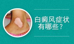 专科北京白癜风医院：患者长白斑的症状有哪些