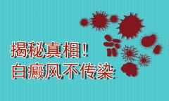 北京白癜风安全的医院：儿童白癜风传染吗?