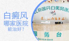 北京白癜风要怎么治疗?北京白癜风医院治疗哪家