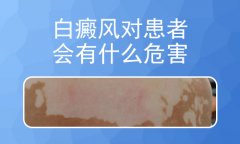北京治白癜风权威医院肢端型白癜风对患者造成